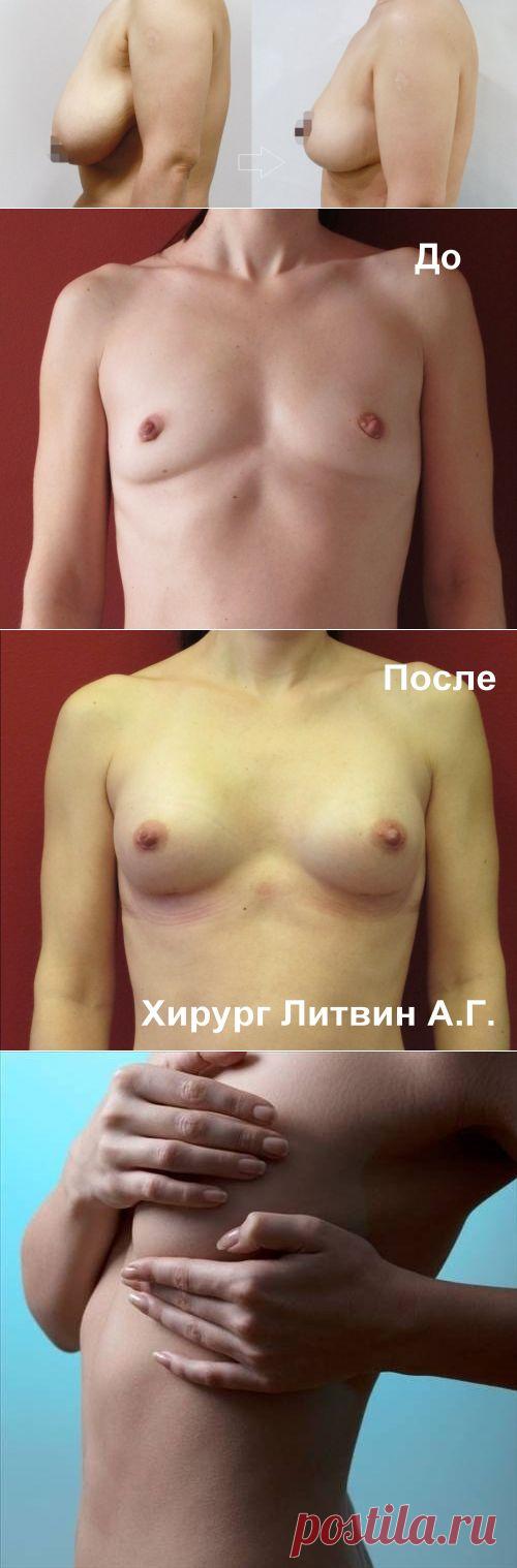 Мастопексия (подтяжка груди): показания, противопоказания, виды, эндоскопическая, подготовка к операции, осложнения