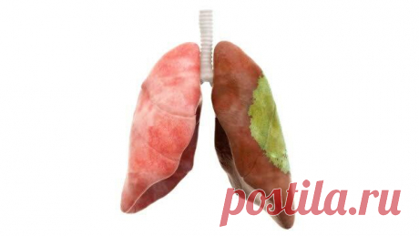 Как восстановить легкие после ковида?
Слева — здоровое легкое. Справа — легкое, покрытое рубцовой тканью из-за фиброза. Слева — здоровое легкое. Справа — легкое, покрытое рубцовой тканью из-за фиброза. Модная ныне болезнь — ковид — оказалась не банальным гриппом, а серьезным вирусным заболеванием. Ковид поражает и легкие, и нервную систему, и повышает риск образования тромбов. Но все-таки больше всего при […]
Читай дальше на сайте. Жми подробнее ➡
