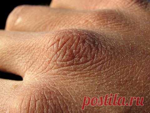 Лечим сухость, шелушение, цыпки на руках
У каждого человека хоть раз появлялись неприятные цыпки на руках, вызывающие ужасный зуд и даже ранки. Кожа, на которой образуются цыпки, очень чувствительна, поэтому нуждается в особенном уходе. Как бороться с этим ненавистным зимним явлением? Как выглядят цыпки, и какими они бывают? Цыпки, как правило, возникают на руках у детей, которые долгое время играют на […]
Читай дальше на сайте. Жми подробнее ➡