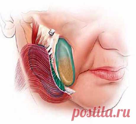 Медовый лифтинг массаж для омоложения овала лица Экология красоты: Брыли чаще всего возникают в солидном возрасте как следствие снижения тонуса мышц и кожных тканей лица в общем и ослабления жевательной мышцы в частности. С возрастом кожа теряет эластичность, мышцы – былую упругость, и тяжёлые щёки под весом подкожно-жировых тканей провисают, создавая эффект бульдожьих щёк.