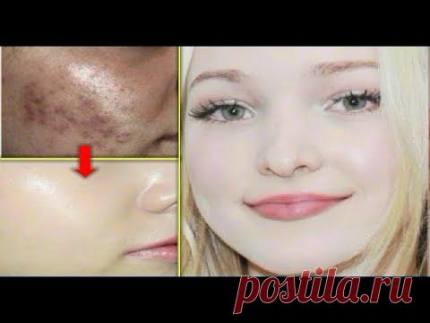 ДЕТСКАЯ КОЖА, КАК СНЕГ, 3 РАЗА | Отбеливание кожи - Средство для удаления пятен, средство для удален