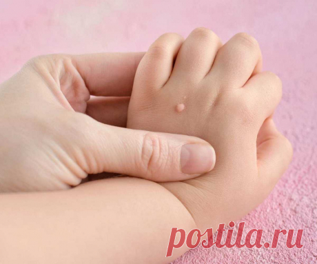 Заговор от бородавок и папиллом – читать для избавления. Методы удаления куриной бородавки в домашних условиях аптечными препаратами и народными рецептами. Обзор эффективных заговоров от куриной жопки Что такое бородавка? Причины возникновения, диагностику и методы лечения разберем в статье доктора Вильшонков А. И., дерматолога со стажем в 39 лет. При ороговении затромбированные капилляры можно разглядеть, только если убрать ороговевший слой кожи. Кожный рисунок подошвы ис...