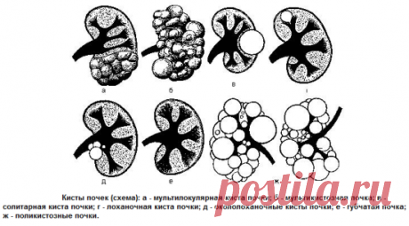Киста почки - причины заболевания, симптомы и методы лечения