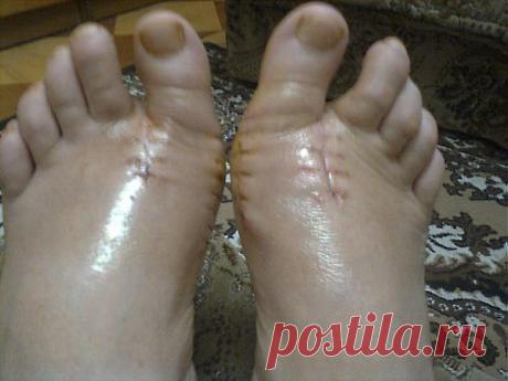 Подагра (наросты на костях).