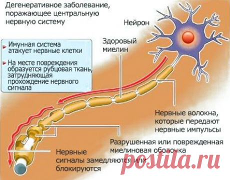Рассеянный склероз: первые признаки