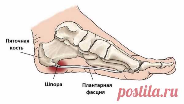 Рекомендации народной медицины для лечения пяточной шпоры
