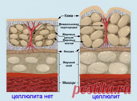 Целлюлит (гиноидная липодистрофия)


 

 

В косметологии под «целлюлитом» (cellulite) понимают особенность женской подкожно-жировой клетчатки, характеризующуюся дольчатым её строением, нарушением циркуляции крови и лимфы, ослаблением тонуса кожи, которая внешне проявляется как косметический недостаток кожи.

Данное название является достаточно спорным, поскольку в терминологии ВОЗ под целлюлитом понимают панникулит. Поэтому в медицинской литературе «целлюлит» (как космети...