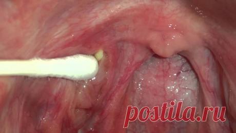 4 эффективных способа удаления миндальных камней без хирургии Действительно помогает! Человеку легко почувствовать себя немного странно, когда они замечают, что у них есть маленькие белые самородки, помещенные в их