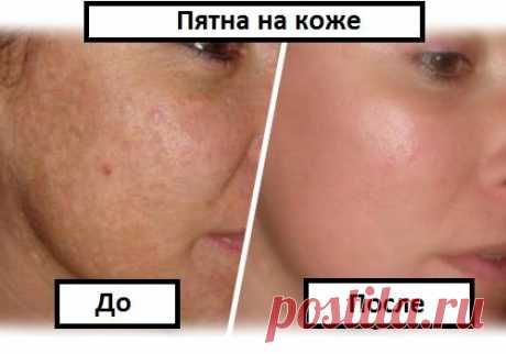 Простой способ избавиться от пигментных пятен