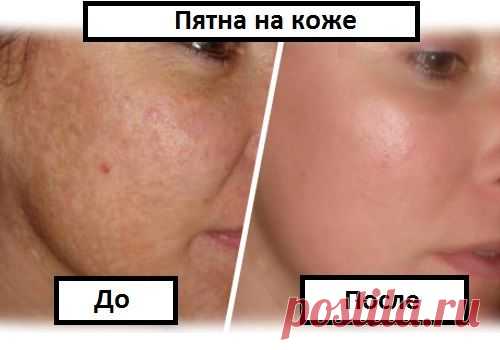 Простой способ избавиться от пигментных пятен