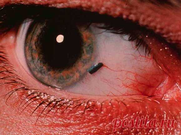 Как убрать соринку из глаза?