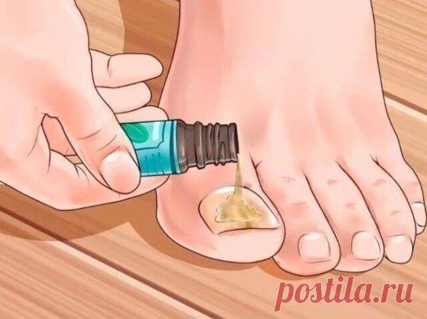 Лечим грибок ногтей
 
1 ложку нашатырного спирта необходимо развести в стакане воды. 
В этом растворе необходимо смочить любую ткань, но только не синтетическую. Этой тряпкой необходимо обернуть пораженный палец, наверх надеть целлофановый пакет, а затем носок. 
Эти действия необходимо повторить в течение 5 дней, после чего грибок исчезнет. 
 
Можно приготовить мазь из сырого куриного яйца, 1 столовой ложки уксуса, 1 столовой ложки растительного масла и 1 чайной ложки диме...