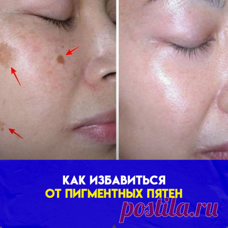 МАСКА ИЗ ПЕТРУШКИ:Корень или листья петрушки разотри до однородной массы и нанеси на чистое лицо, оставь на полчаса. После смывания маски обязательно увлажни кожу кремом. Петрушка осветляет кожу и делает ее гладкой.
МАСКА ИЗ ПЕТРУШКИ И СЛИВОК:Средство, идеальное для сухой кожи. Растертую петрушку смешай со сливками или сметаной и нанеси маску на полчаса. Сухую кожу, склонную к дряблости, следует отбеливать очень осторожно. Это средство нежно действует на кожу, не пересушивая ее.