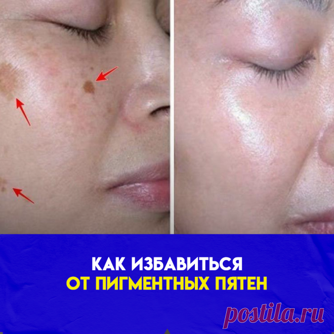 МАСКА ИЗ ПЕТРУШКИ:Корень или листья петрушки разотри до однородной массы и нанеси на чистое лицо, оставь на полчаса. После смывания маски обязательно увлажни кожу кремом. Петрушка осветляет кожу и делает ее гладкой.
МАСКА ИЗ ПЕТРУШКИ И СЛИВОК:Средство, идеальное для сухой кожи. Растертую петрушку смешай со сливками или сметаной и нанеси маску на полчаса. Сухую кожу, склонную к дряблости, следует отбеливать очень осторожно. Это средство нежно действует на кожу, не пересушивая ее.