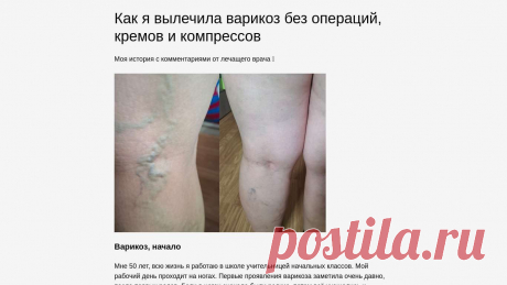 ​Как я вылечила ВАРИКОЗ БЕЗ ОПЕРАЦИЙ, кремов и компрессов