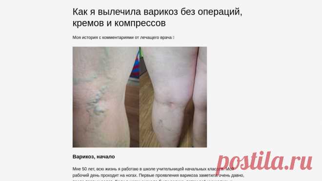 ​Как я вылечила ВАРИКОЗ БЕЗ ОПЕРАЦИЙ, кремов и компрессов
