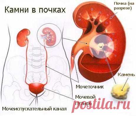 Песок в почках...??? Растворяем...