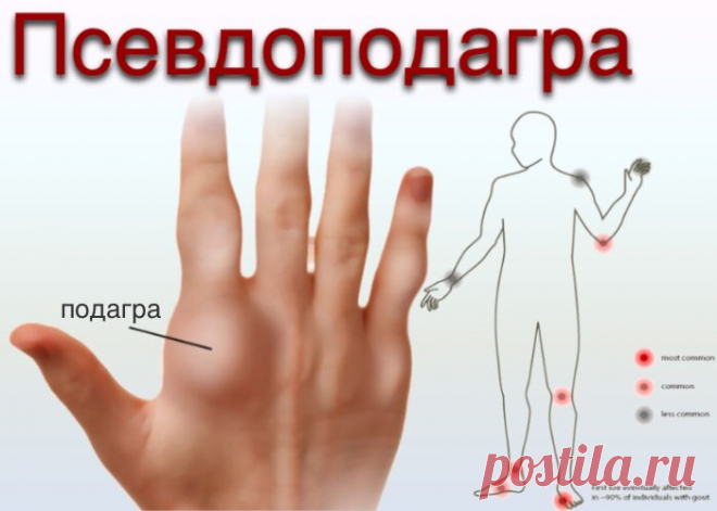 doclvs.ru | Псевдоподагра: причины, симптомы, диагностика, лечение