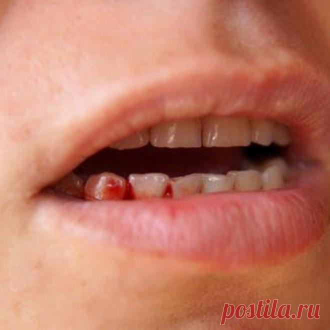 15 признаков лейкемии, которые мы часто игнорируем