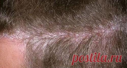Чем и как лечить псориаз на голове, симптомы, фото, виды