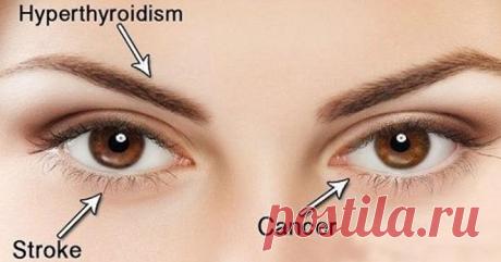 10 вещей, которые ваши глаза пытаются рассказать вам о вашем здоровье - Журнал Советов Знаете ли вы, что ваши глаза – окно в здоровье? Yahoo Health придумал список из 10 вещей, которые ваши глаза могут рассказать о вашем теле. Вот некоторые из них: Исчезающие брови Когда бровь начинает исчезать, это признак заболевания щитовидной железы (гипотиреоз). Ячмень, который не проходит Это может указывать на редкий рак, называемый раком сальных желез. Нечеткое зрение […]