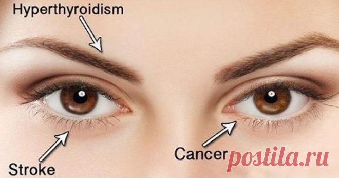 10 вещей, которые ваши глаза пытаются рассказать вам о вашем здоровье - Журнал Советов Знаете ли вы, что ваши глаза – окно в здоровье? Yahoo Health придумал список из 10 вещей, которые ваши глаза могут рассказать о вашем теле. Вот некоторые из них: Исчезающие брови Когда бровь начинает исчезать, это признак заболевания щитовидной железы (гипотиреоз). Ячмень, который не проходит Это может указывать на редкий рак, называемый раком сальных желез. Нечеткое зрение […]