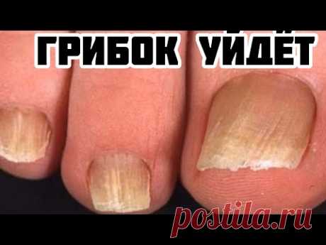 НАНЕСЛА ПАРУ КАПЕЛЬ на НОГОТЬ и ГРИБОК ИСЧЕЗ! ПРОВЕРЕНО