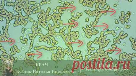 ГЕМОСКАНИРОВАНИЕ после лечения АНТИБИОТИКАМИ при КОВИД. Гемосканирование. Кровь.