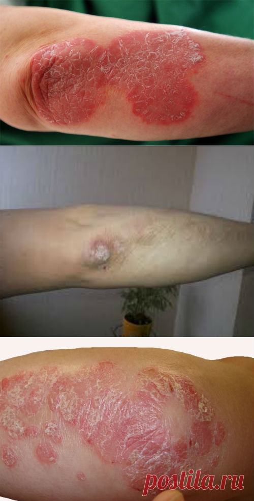 Псориаз на локтях, причины и лечение