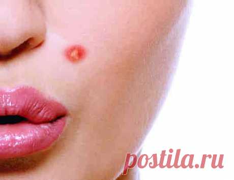 Что такое розовые угри и как с ними бороться? — Всегда в форме!