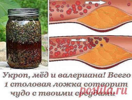 Укроп, мёд и валериана! Всего 1 столовая ложка сотворит чудо с твоими сосудами.
К сожалению, наши кровеносные сосуды имеют свойство загрязняться. Они накапливают на своих стенках отложения неорганических солей, что в дальнейшем является причиной развития атеросклероза, нарушения кровообращения, повышенного давления и варикоза.
Поэтому рекомендуется регулярно проводить курс очищения кровеносной системы. Сегодня наша редакция поделится с тобой проверенным методом очищения сосудов…
Как почистить