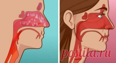 Как остановить гайморит за 20 секунд!
