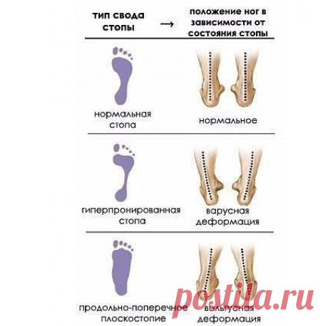 Комплекс упражнений для лечения плоскостопия.