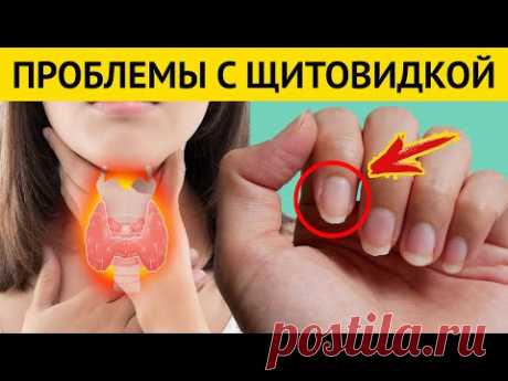 Ваша ЩИТОВИДКА «кричит» о ПРОБЛЕМАХ. Признаки серьезных проблем с щитовидной железой - YouTube