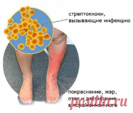 Рожа — болезнь молодых мужчин и пожилых женщин