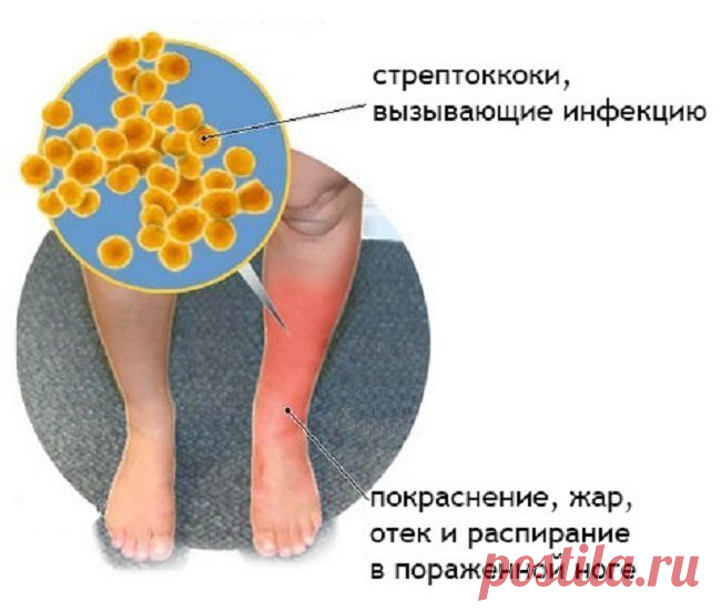 Рожа — болезнь молодых мужчин и пожилых женщин