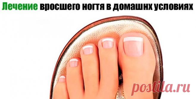 Вросший ноготь. Лечение и удаление вросшего ногтя дома &laquo;  Будь Здоров
