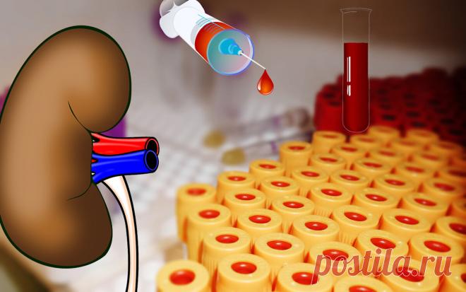 Как с помощью креатинина крови оценить функцию почек?
Патология почек — огромная проблема, которой страдают около 850 млн человек во всем мире. Заболевания почек опасны тем, что в большинстве случаев они приводят к развитию патологии, которая в конечном счете является основной причиной ухода из жизни многих пациентов. Так, например, хроническая болезнь почек в 4 раза увеличивает риск сердечно-сосудистых заболеваний, в том числе инфаркта […]
Читай дальше на сайте. Жми подробнее ➡