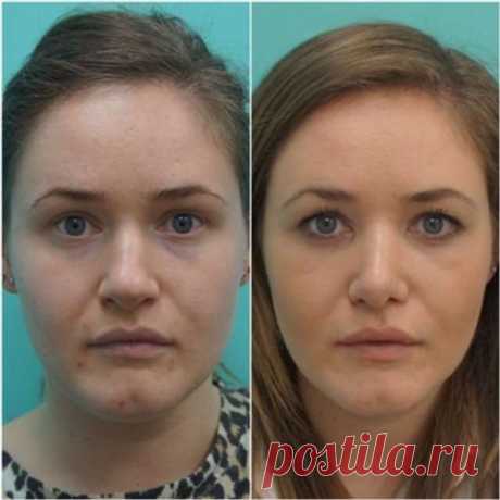 Что происходит с лицом людей, когда они удаляют комки Биша. 10 фото до и после | Люблю Себя