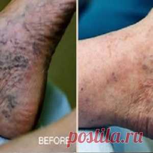 Самое эффективное средство от варикоза и геморроя
