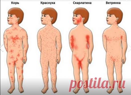 Кір, вітрянка чи краснуха: яk зрозуміти, що за хвороба вразила вас або вашу дитину, якщо вона супроводжується червоними висипаннями? Кір, вітрянка або краснуха: як відрізнити їх один від одного.

У 2018 році в Україні стався спалах кору, і поки що ситуація залишається невтішною. Джерело

За даними Міністерства охорони здоров'я, з початку 2019 року понад 5000 осіб захворіли на кір. Не дивно, що люди панікують, побачивши у себе