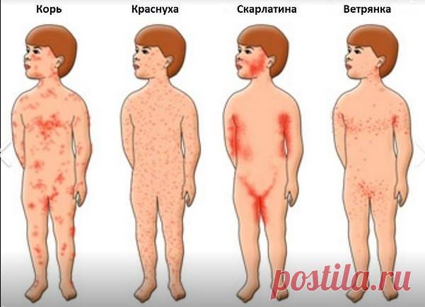 Кір, вітрянка чи краснуха: яk зрозуміти, що за хвороба вразила вас або вашу дитину, якщо вона супроводжується червоними висипаннями? Кір, вітрянка або краснуха: як відрізнити їх один від одного.

У 2018 році в Україні стався спалах кору, і поки що ситуація залишається невтішною. Джерело

За даними Міністерства охорони здоров'я, з початку 2019 року понад 5000 осіб захворіли на кір. Не дивно, що люди панікують, побачивши у себе
