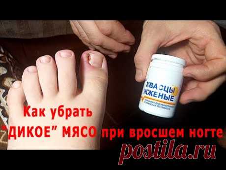 ★ Как без хирурга убрать &quot;дикое&quot; мясо при вросшем ногте. Квасцы жженые -100% результат.