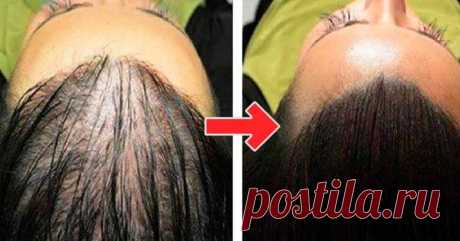 Простой способ восстановить красоту и пышность волос! маска от выпадения! - Образованная Сова Всего 1-2 процедуры в неделю помогут остановить выпадение волос и вернуть им былую красоту! Выпадение волос — это одна из самых раздражающих проблем с волосами, от которой очень сложно избавиться. Конечно, есть допустимая норма выпадения волос в день, таким образом волосы обновляются. Но, чрезмерное выпадение волос может быть серьезной проблемой, которая приводит к образованию залысин …