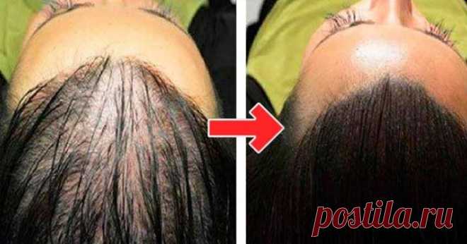 Простой способ восстановить красоту и пышность волос! маска от выпадения! - Образованная Сова Всего 1-2 процедуры в неделю помогут остановить выпадение волос и вернуть им былую красоту! Выпадение волос — это одна из самых раздражающих проблем с волосами, от которой очень сложно избавиться. Конечно, есть допустимая норма выпадения волос в день, таким образом волосы обновляются. Но, чрезмерное выпадение волос может быть серьезной проблемой, которая приводит к образованию залысин …