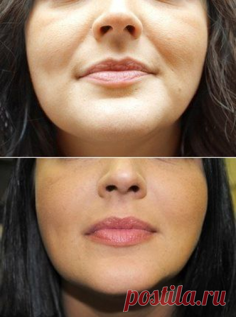 Как избавиться от носогубных складок | Женский журнал