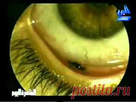 فتاه يخرج من عينها نمل ants come out of girls eye 1/2 - YouTube