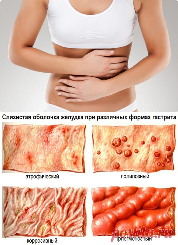 Гастрит: симптомы и причины. Лечение народными средствами