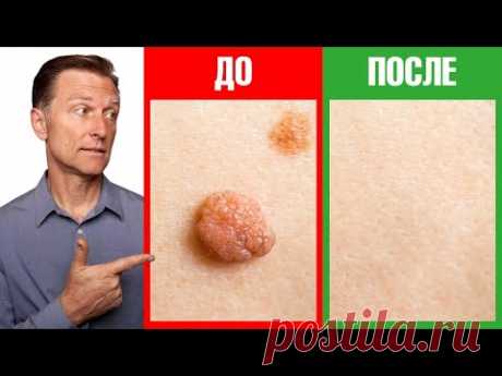 Как избавиться от бородавок и папиллом за 1 день💥