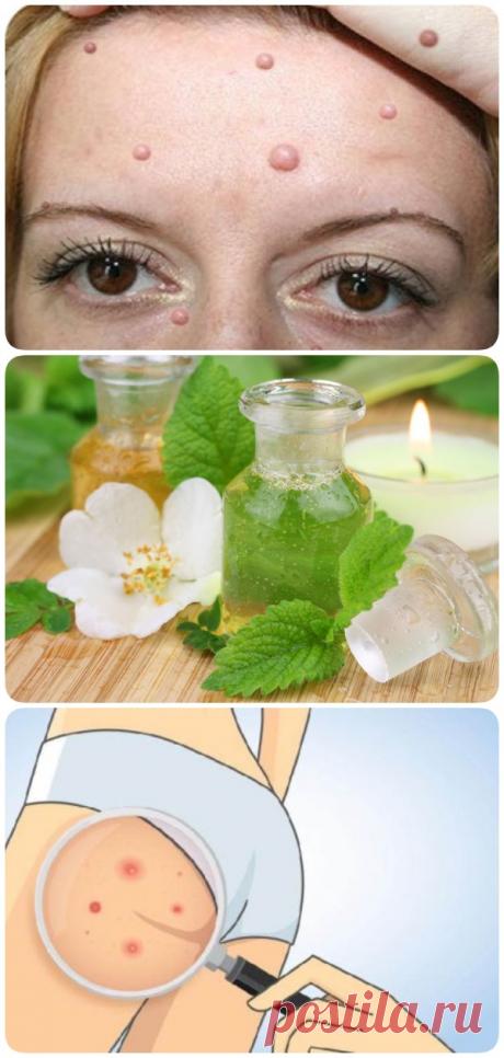 Эти средства избавят от папиллом, бородавок, угрей и возрастных пятен! Просто поразительный эффект! - interesno.win